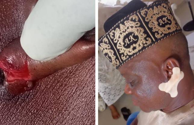 We Had an Altercation which led to a Scuffle and he bit my Ear – Olu of Igbokoda Breaks Silence on Attack, Seeks Justice